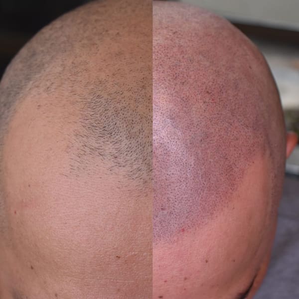 The Scalp Barber Scalp Micropigmentation Hair Loss Solution By Allure - permanent makeup in Sacramento, CA