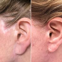 Utah Scar and Stretch Mark Lab - permanent makeup work