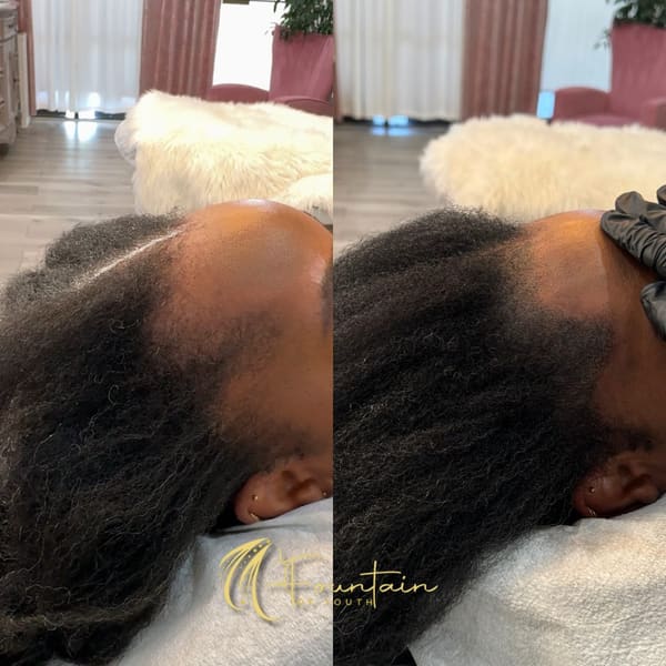 Women’s Scalp Micropigmentation - Fountain of Youth - permanent makeup in Roseville, CA